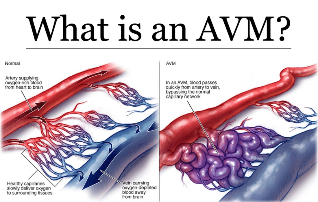 arteriovenous-malformation-1